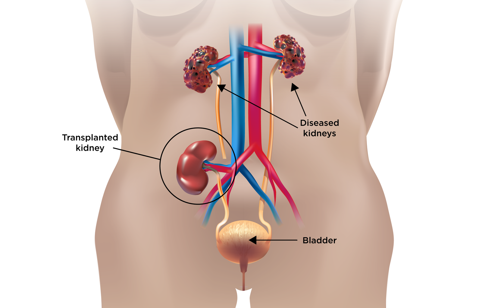 Transplant Nephrology